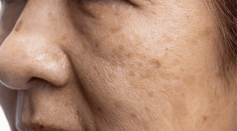 Hyperpigmentation