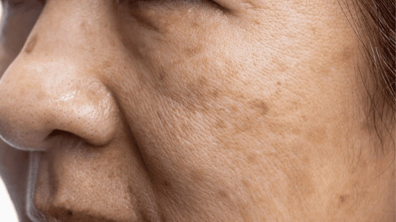 Hyperpigmentation