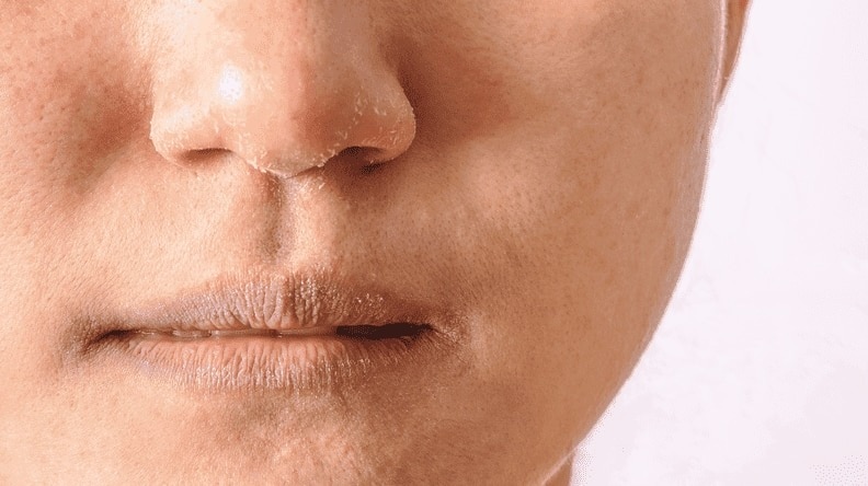 Oily, Acne-Prone Skin