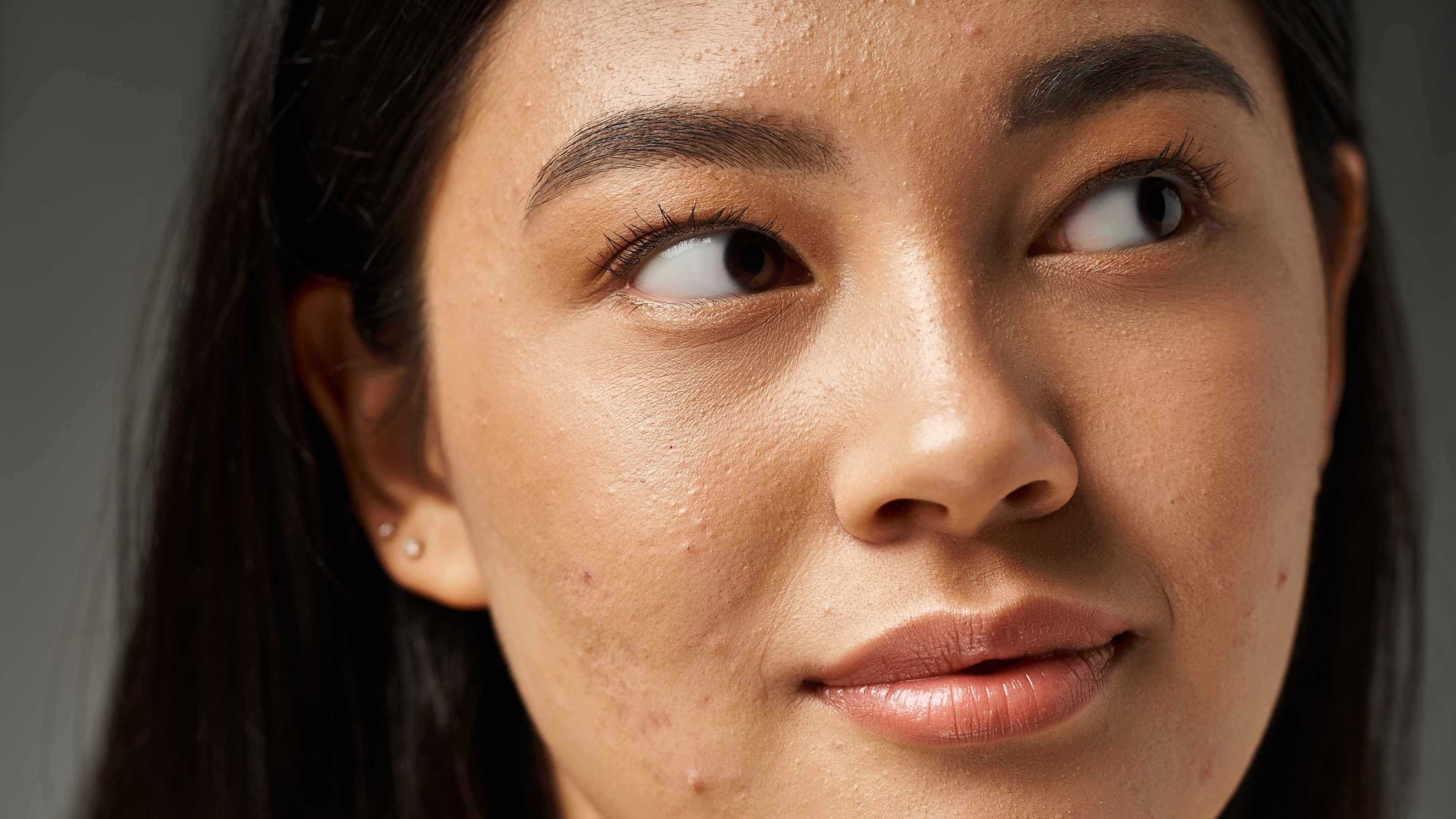 Primary Causes of Pimples on the Face