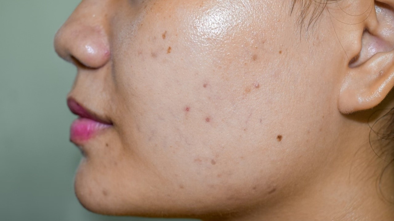 Salicylic Acid for Dark Spots & Acne Scars
