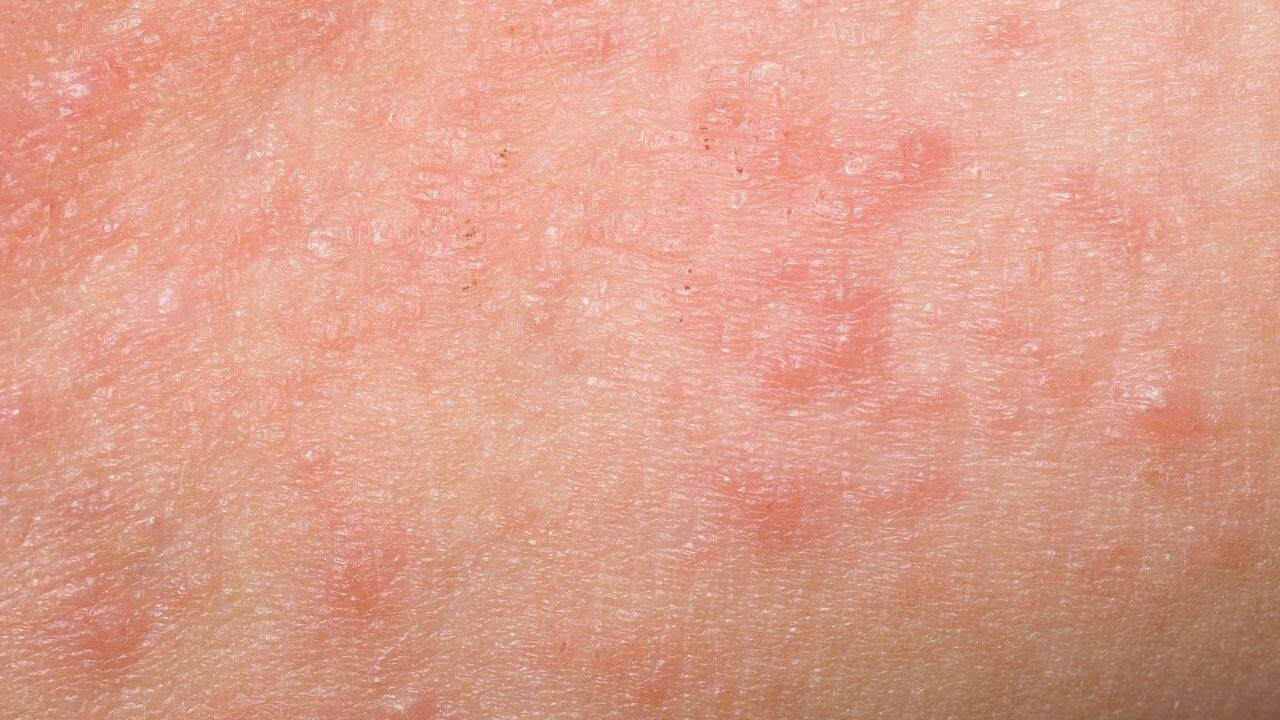 What are the common side effects of laser hair removal?