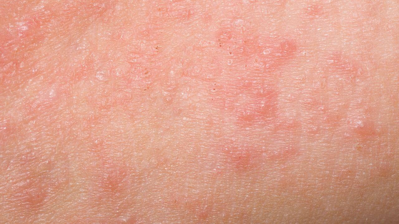 What are the common side effects of laser hair removal?