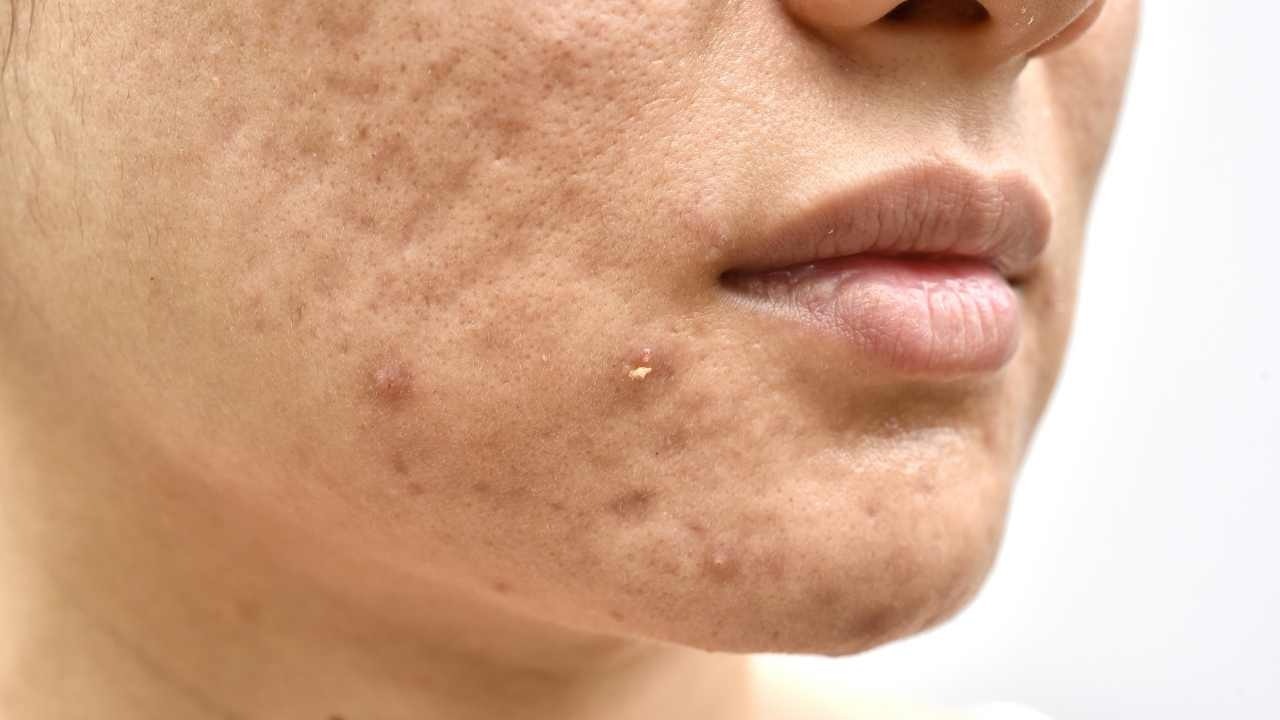 Minimizes the risk of acne and breakouts