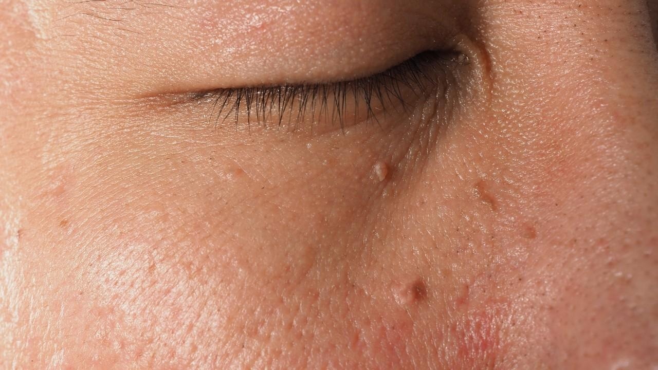 Skin Tags