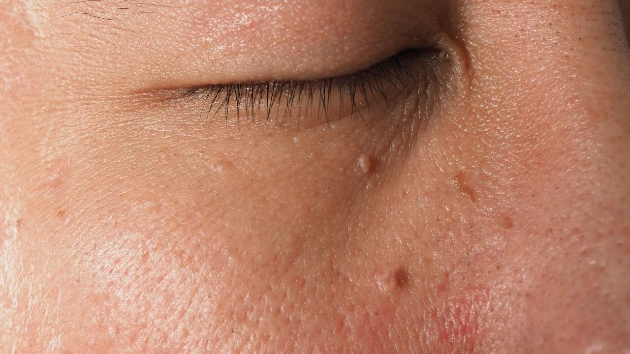 Skin Tags