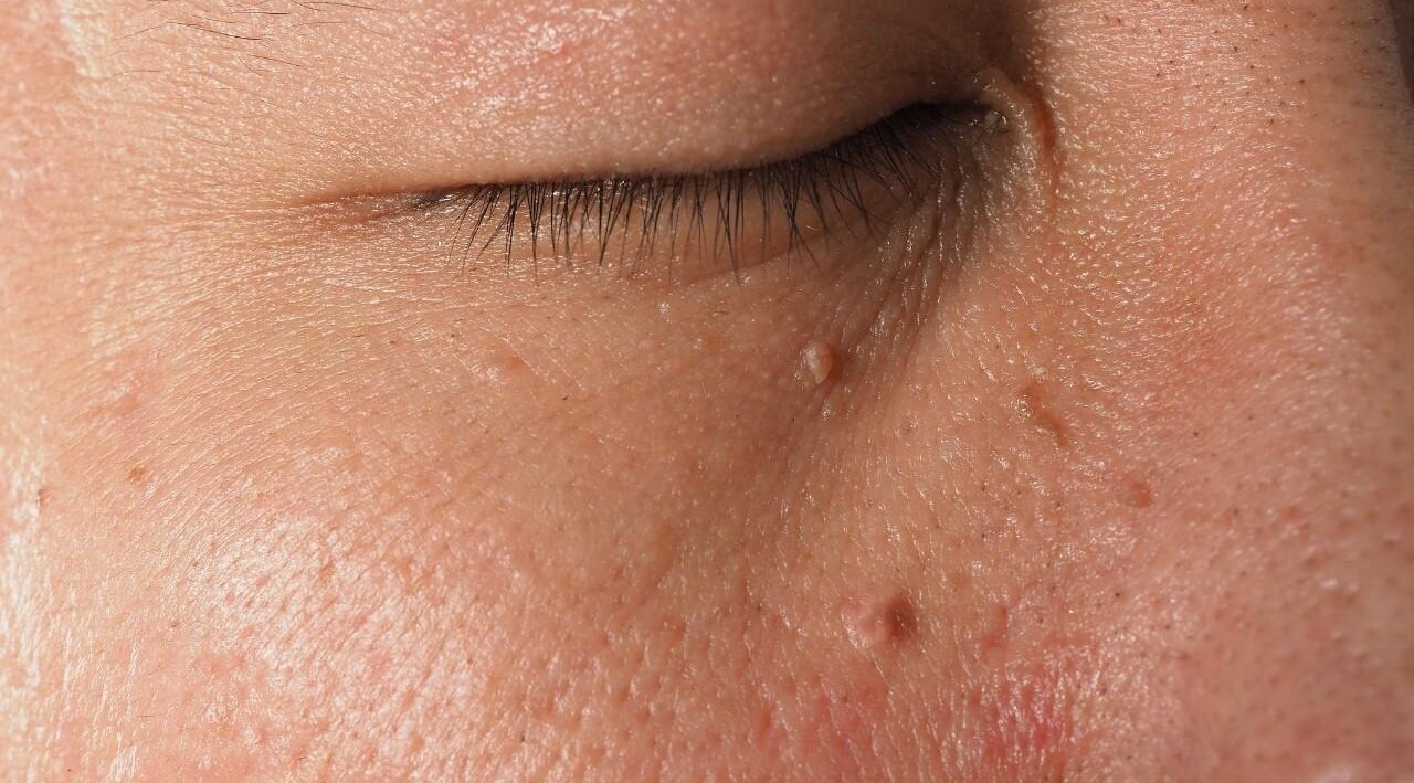 Skin Tags