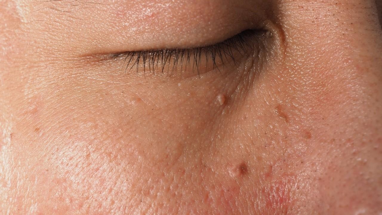 Skin Tags