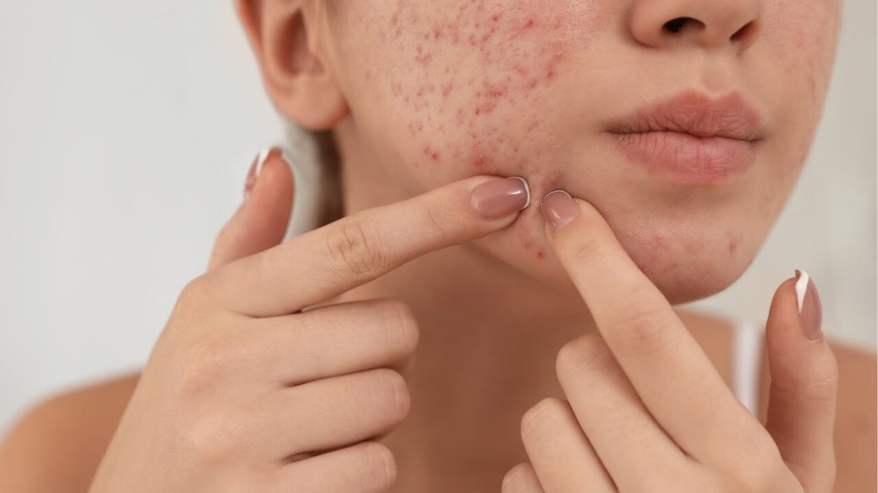 Clears Acne &amp; Prevents Breakouts
