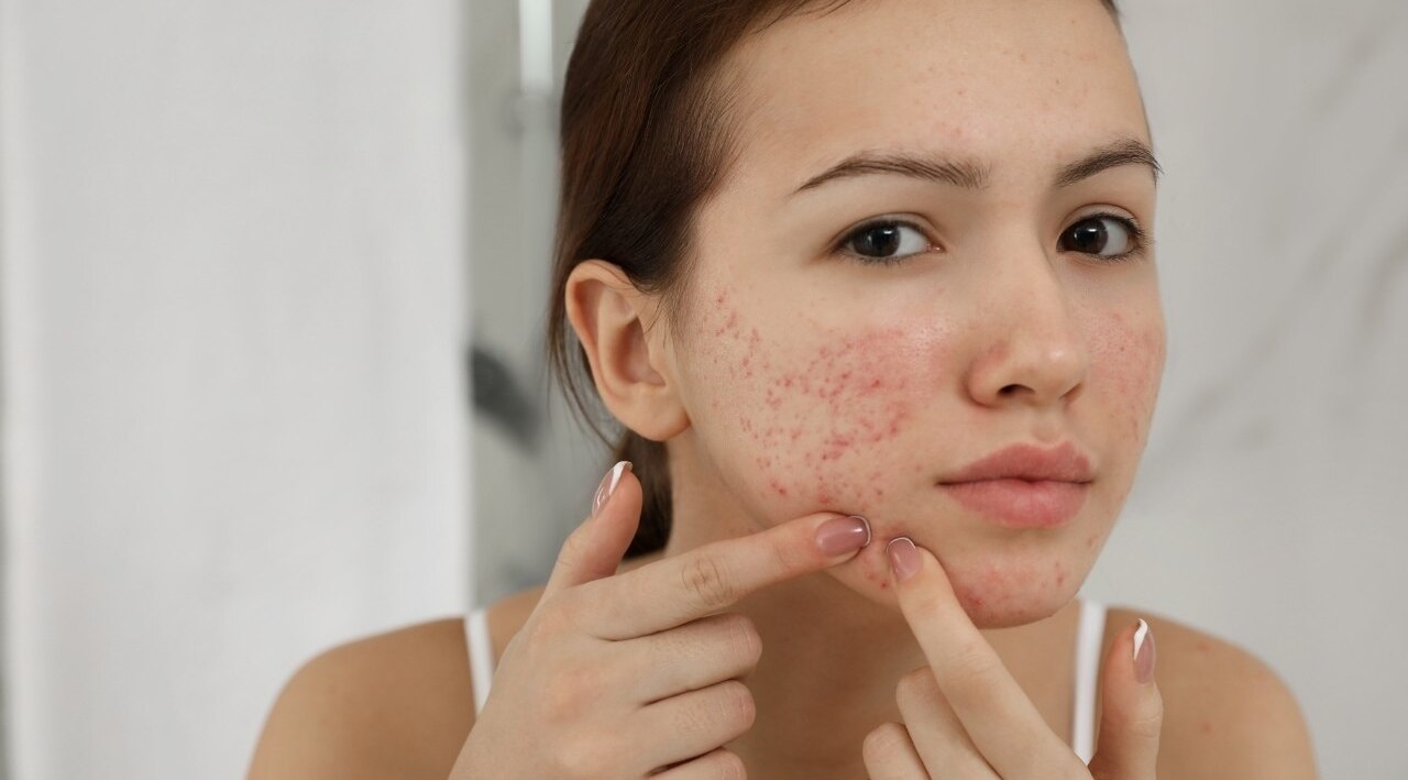 Combats acne