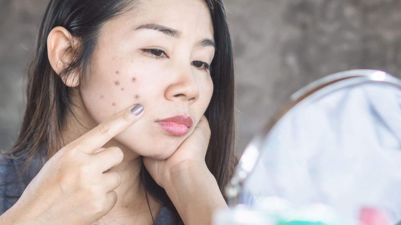 Fades Dark spots &amp; Acne Scars