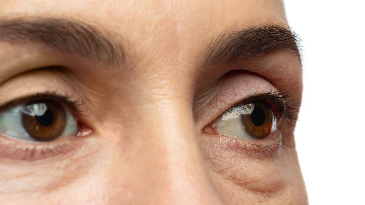 Hidden Food Additives That Cause Puffy Eyes