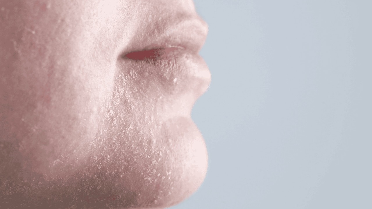 Possible Side Effects of Benzoyl Peroxide