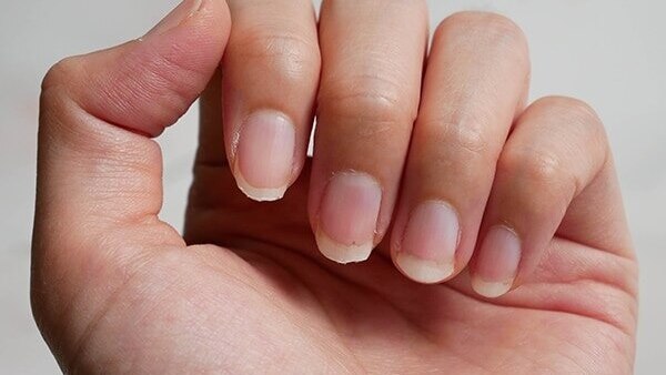 Thin or spooning nails
