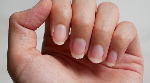 Thin or spooning nails