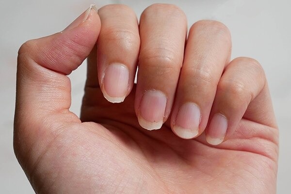 Thin or spooning nails