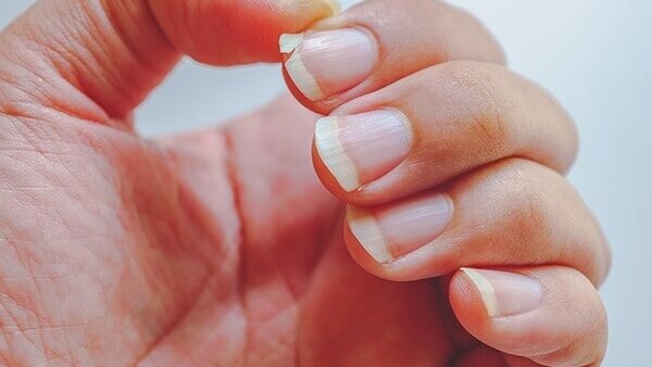 Thin or spooning nails