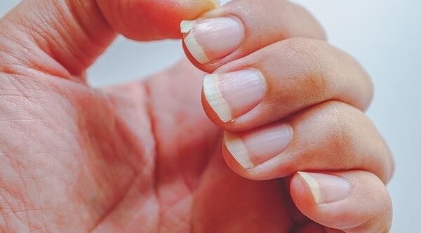 Thin or spooning nails