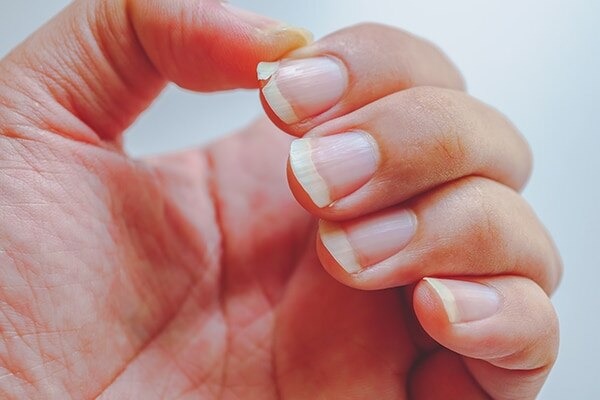 Thin or spooning nails