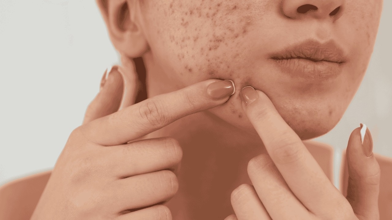 As a Spot Treatment for Acne