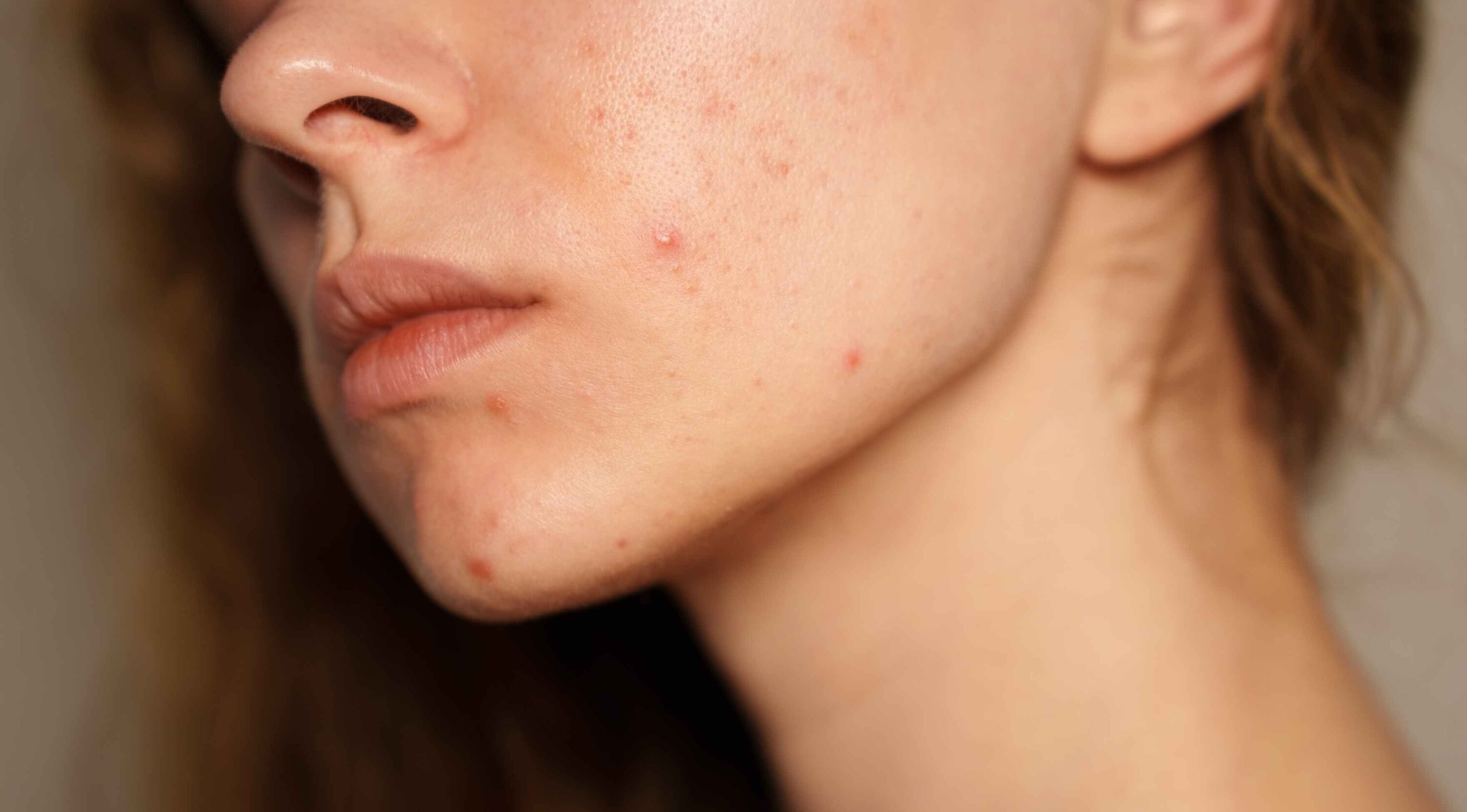 Can Swimming Cause Acne