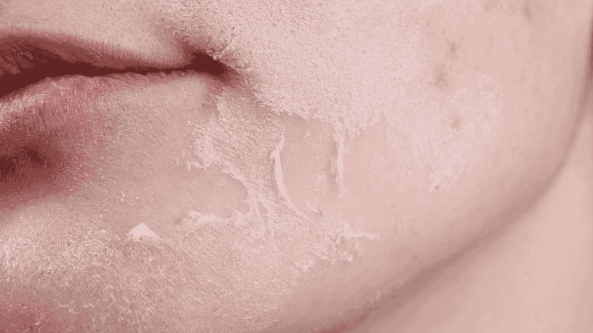 Dry and Itchy Skin