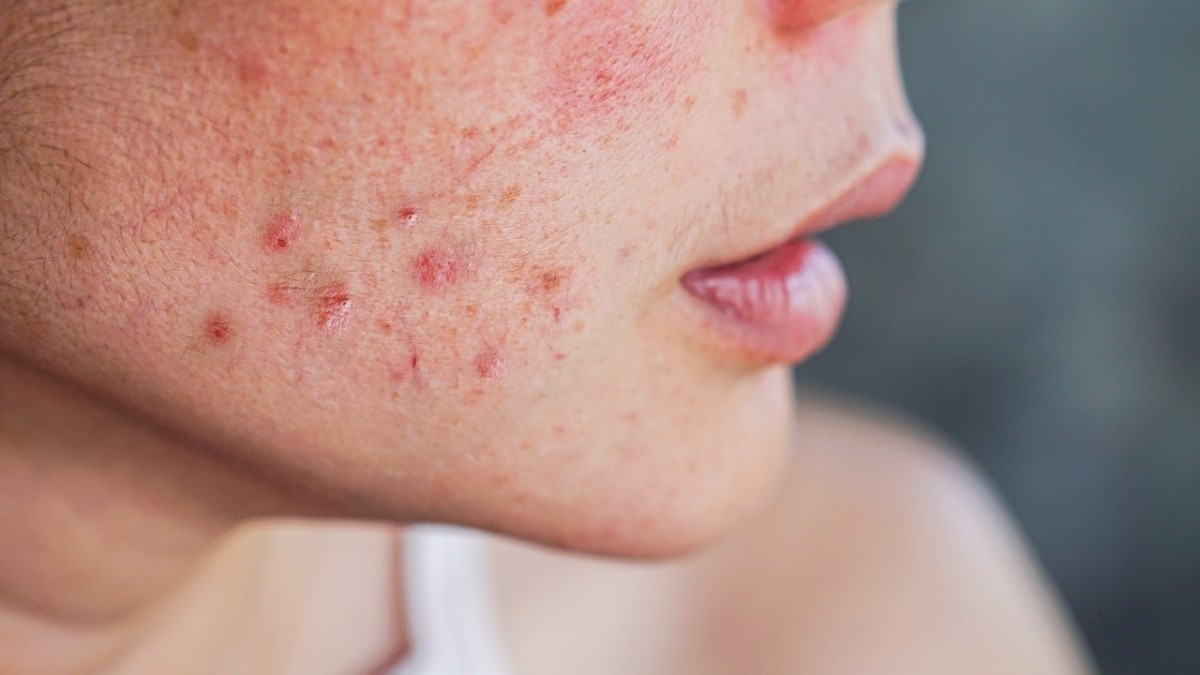 Fights Acne and Blemishes