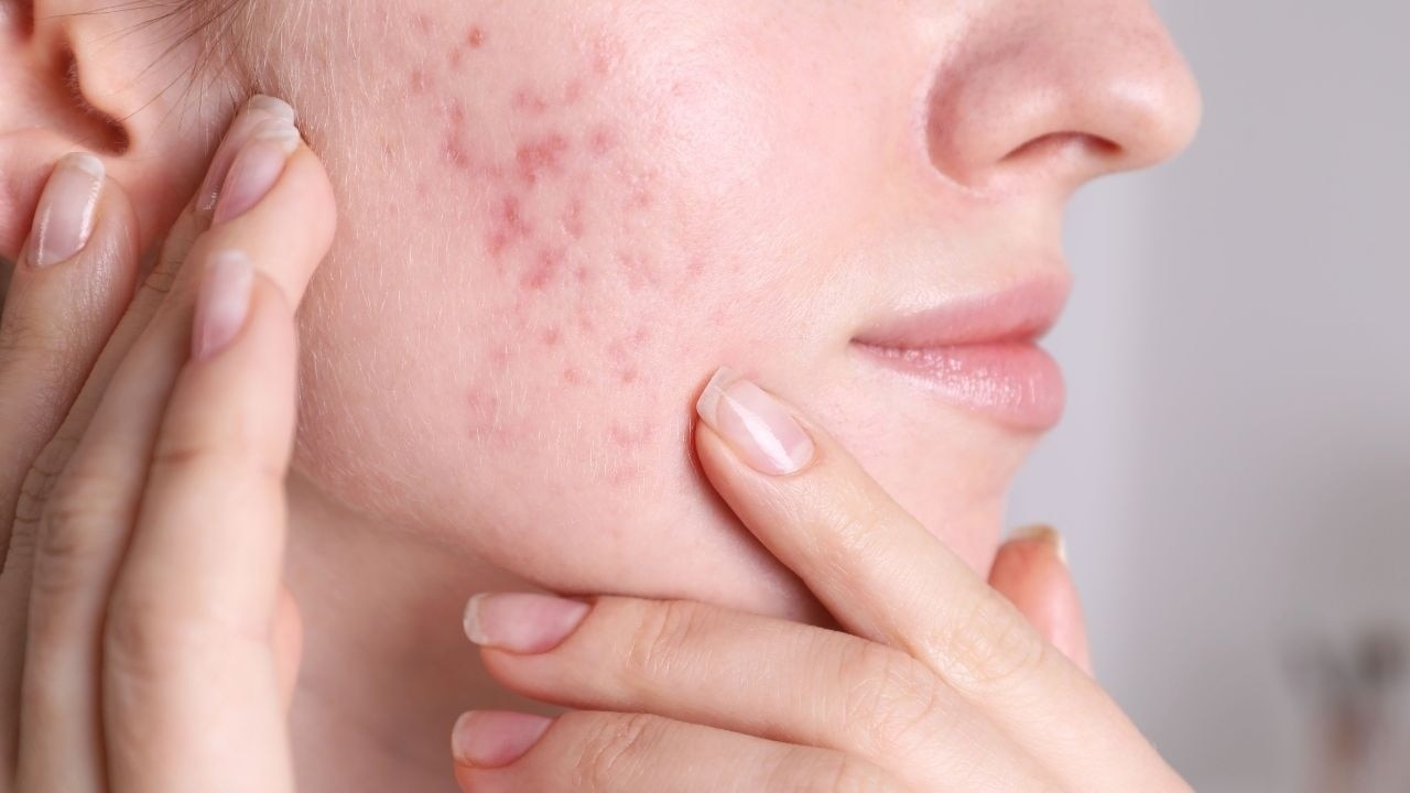Natural Acne Fighter