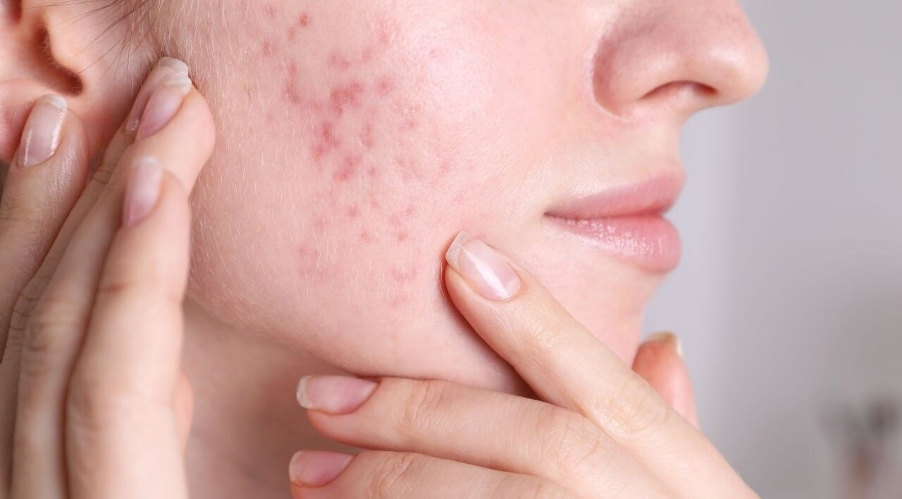 Natural Acne Fighter