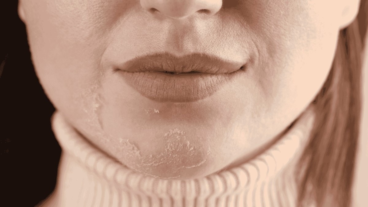 Skin Barrier Damage and Sensitivity