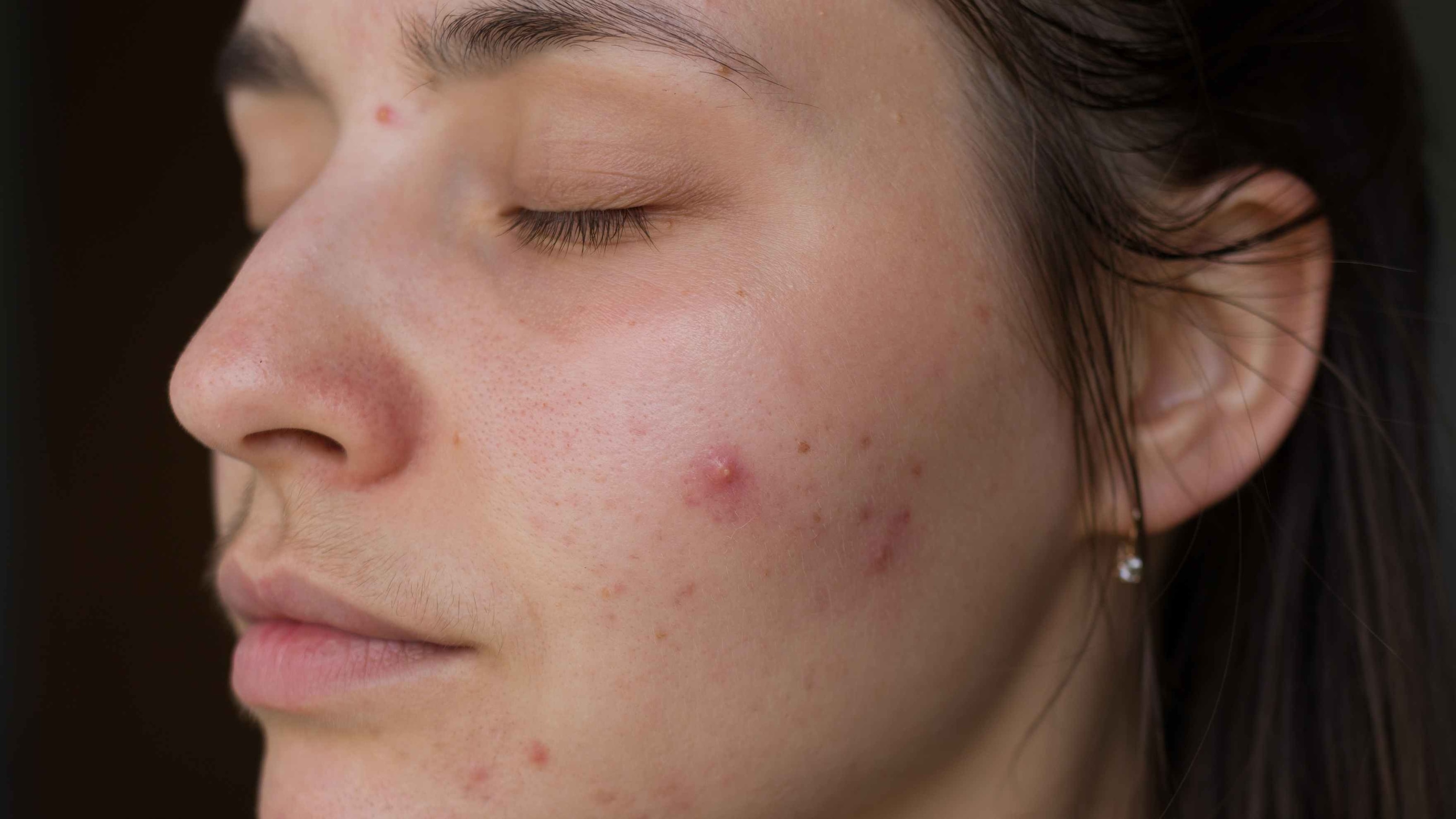 Types of Acne Triggered by Swimming