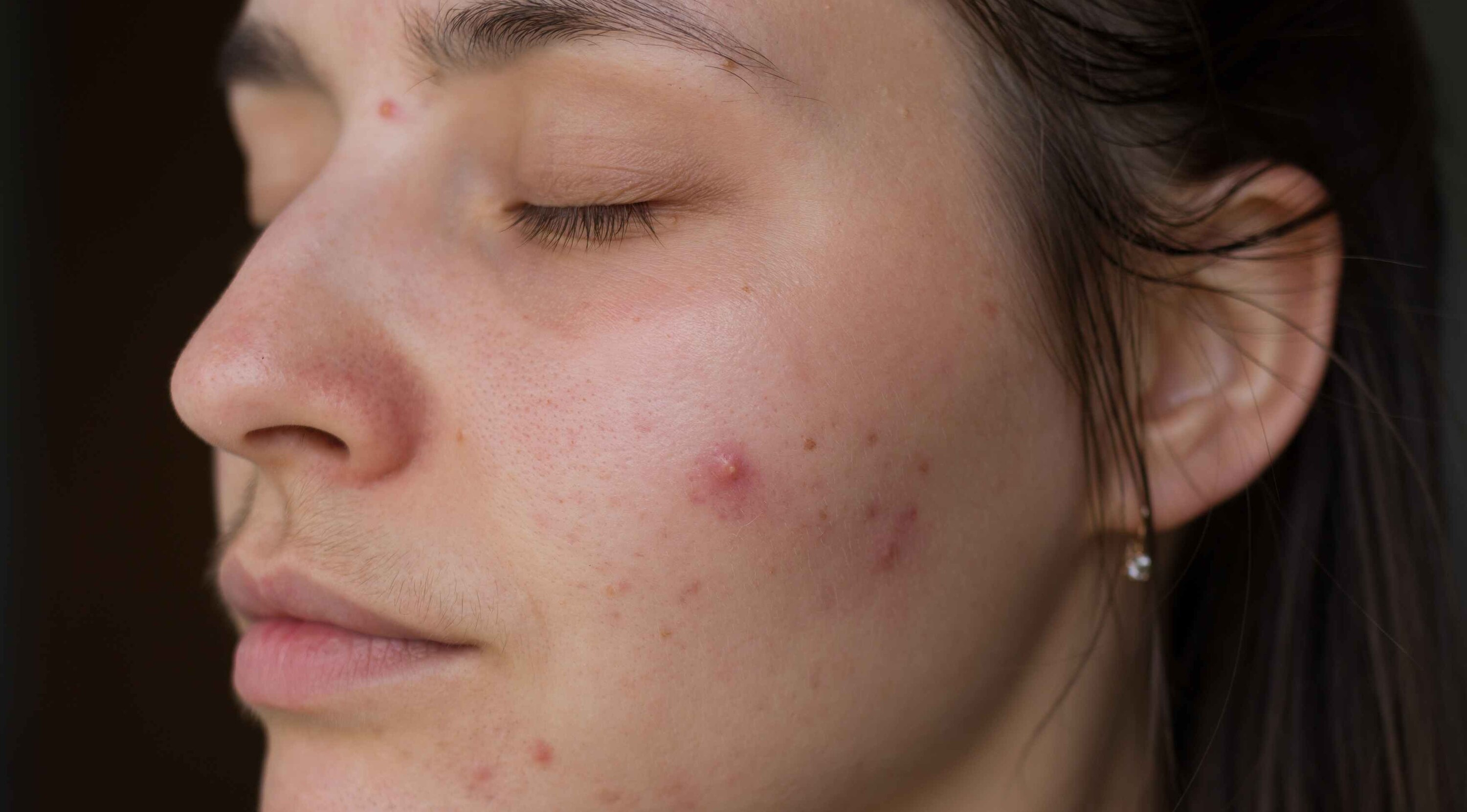Types of Acne Triggered by Swimming