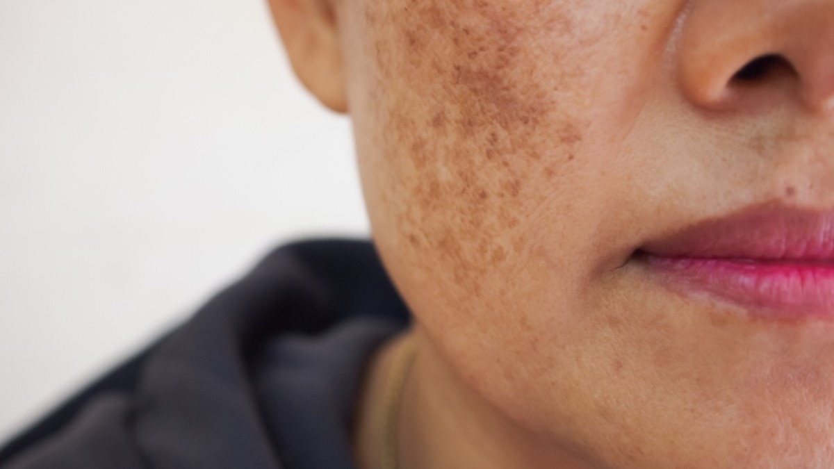 What causes melasma?