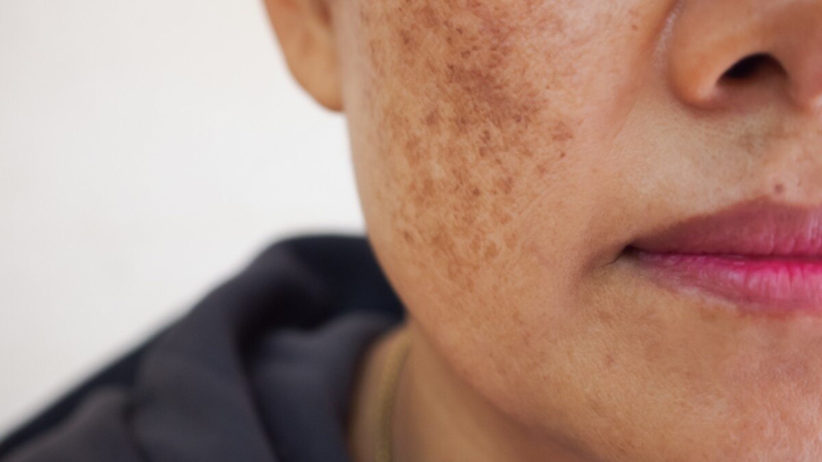 What causes melasma?