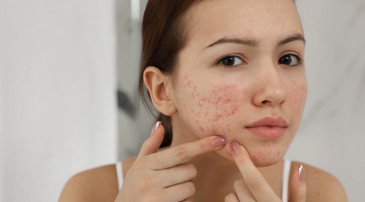 anti-acne face packs