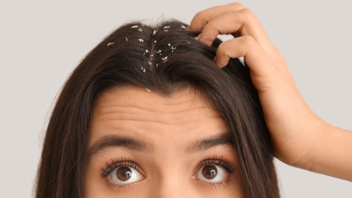 2. Benefit: Does away with dandruff