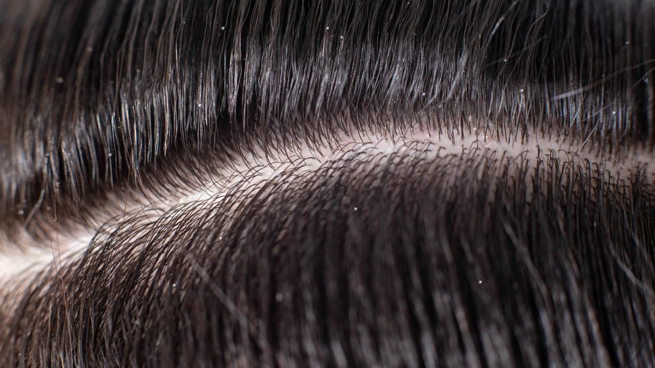 Gets-Rid-of-Dandruff