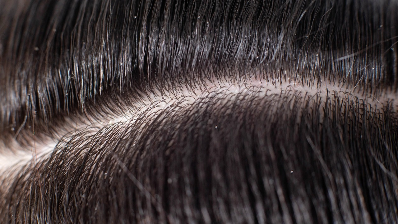 Gets-Rid-of-Dandruff