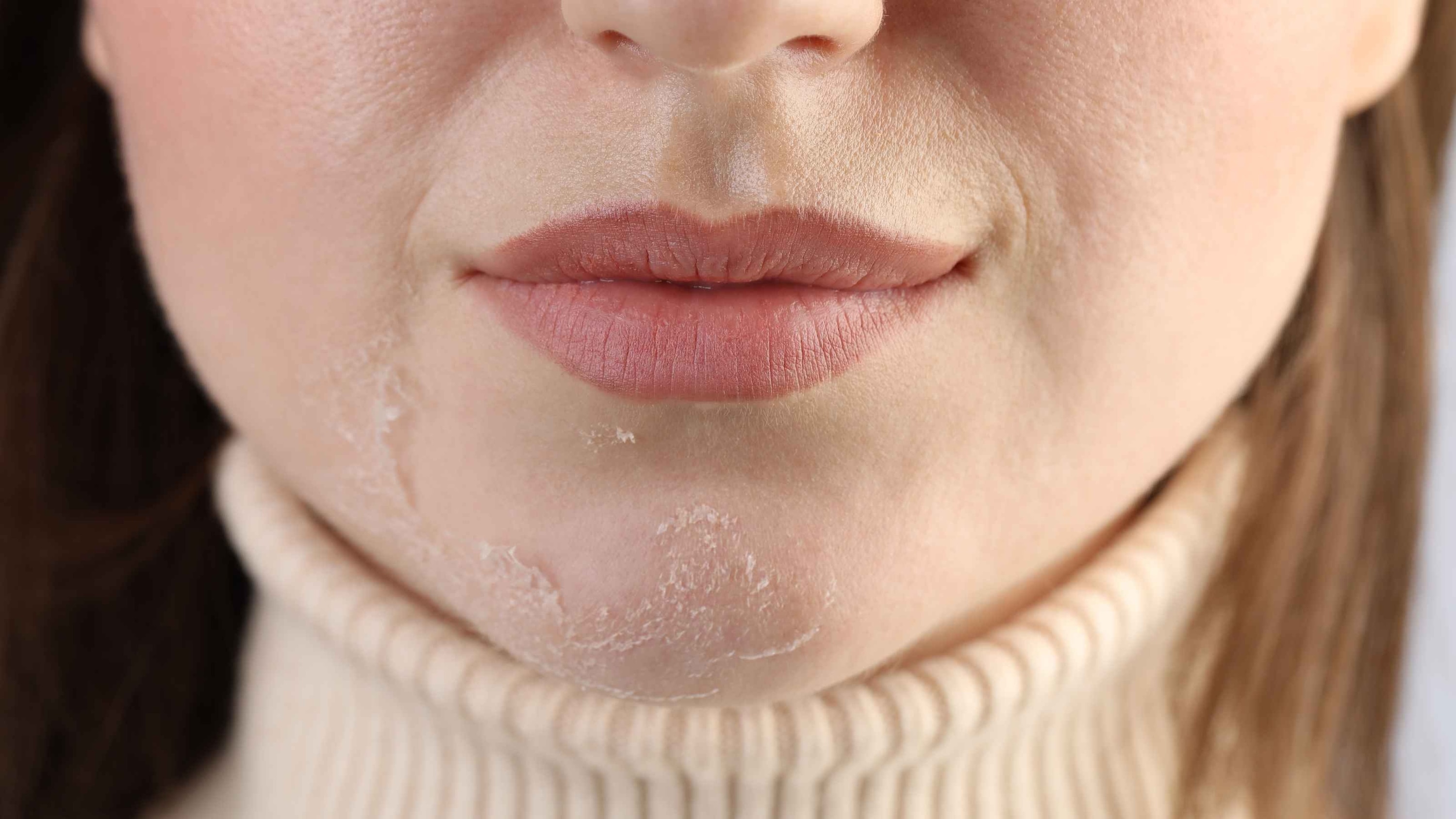 Dry skin