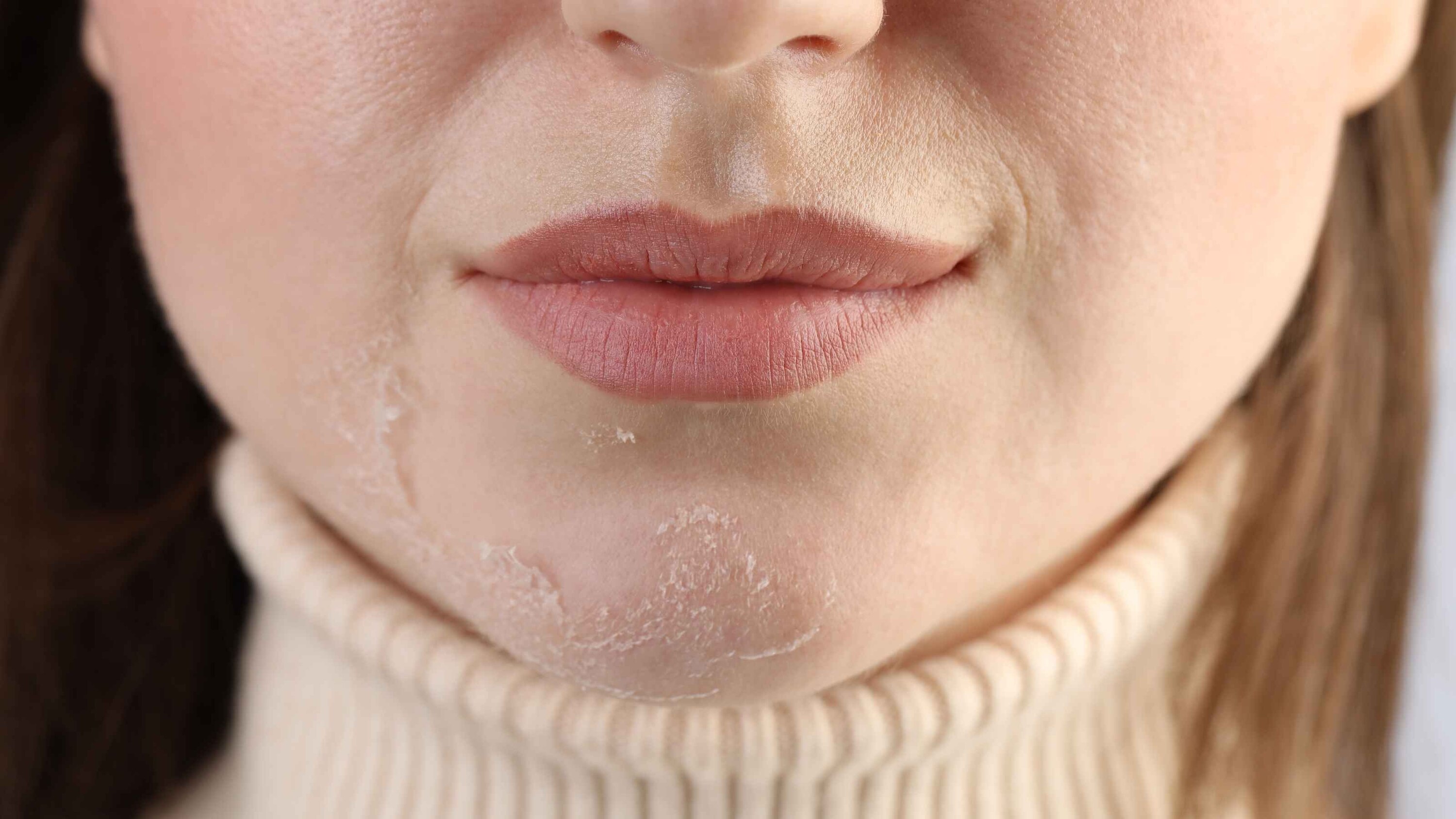 Dry skin