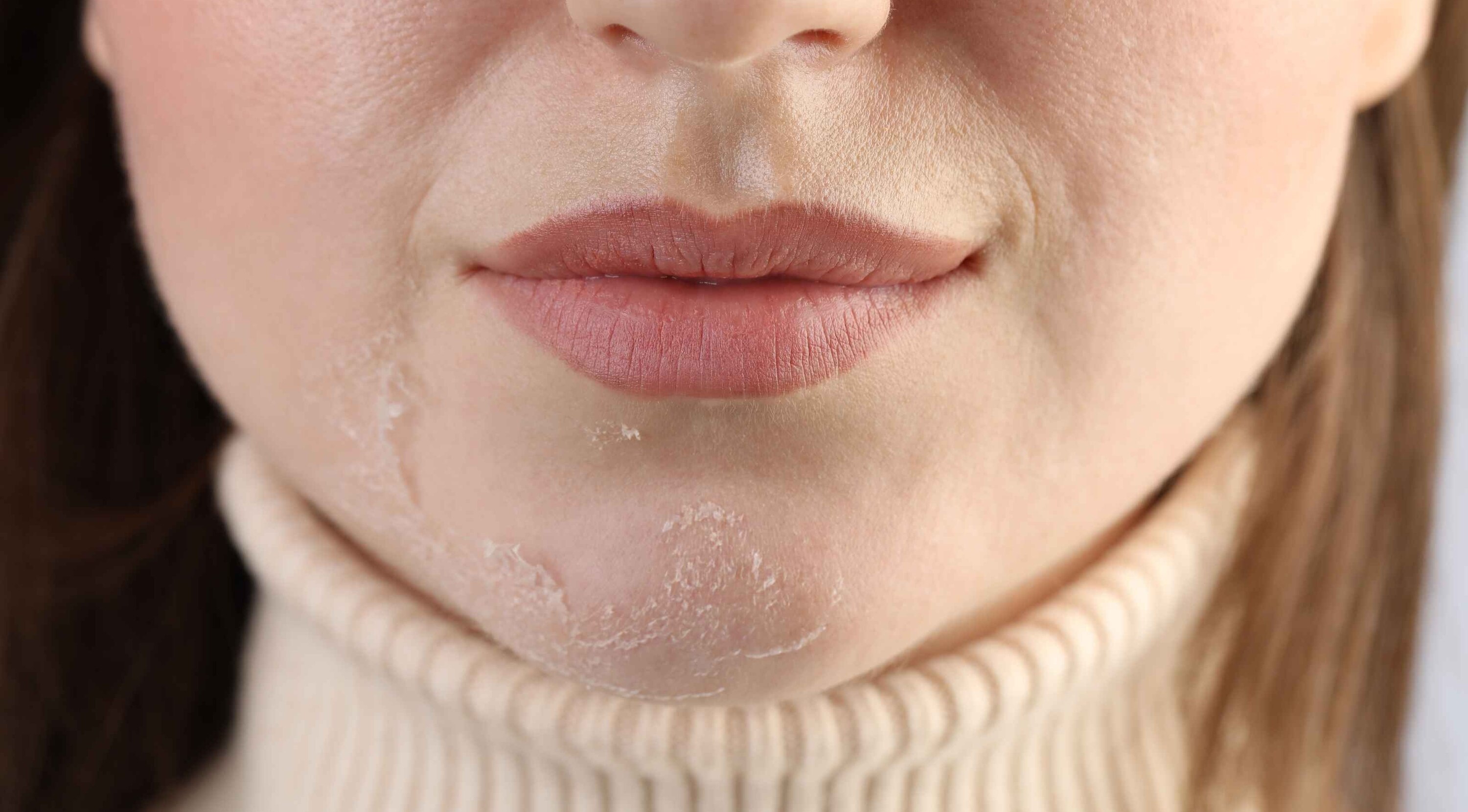 Dry skin