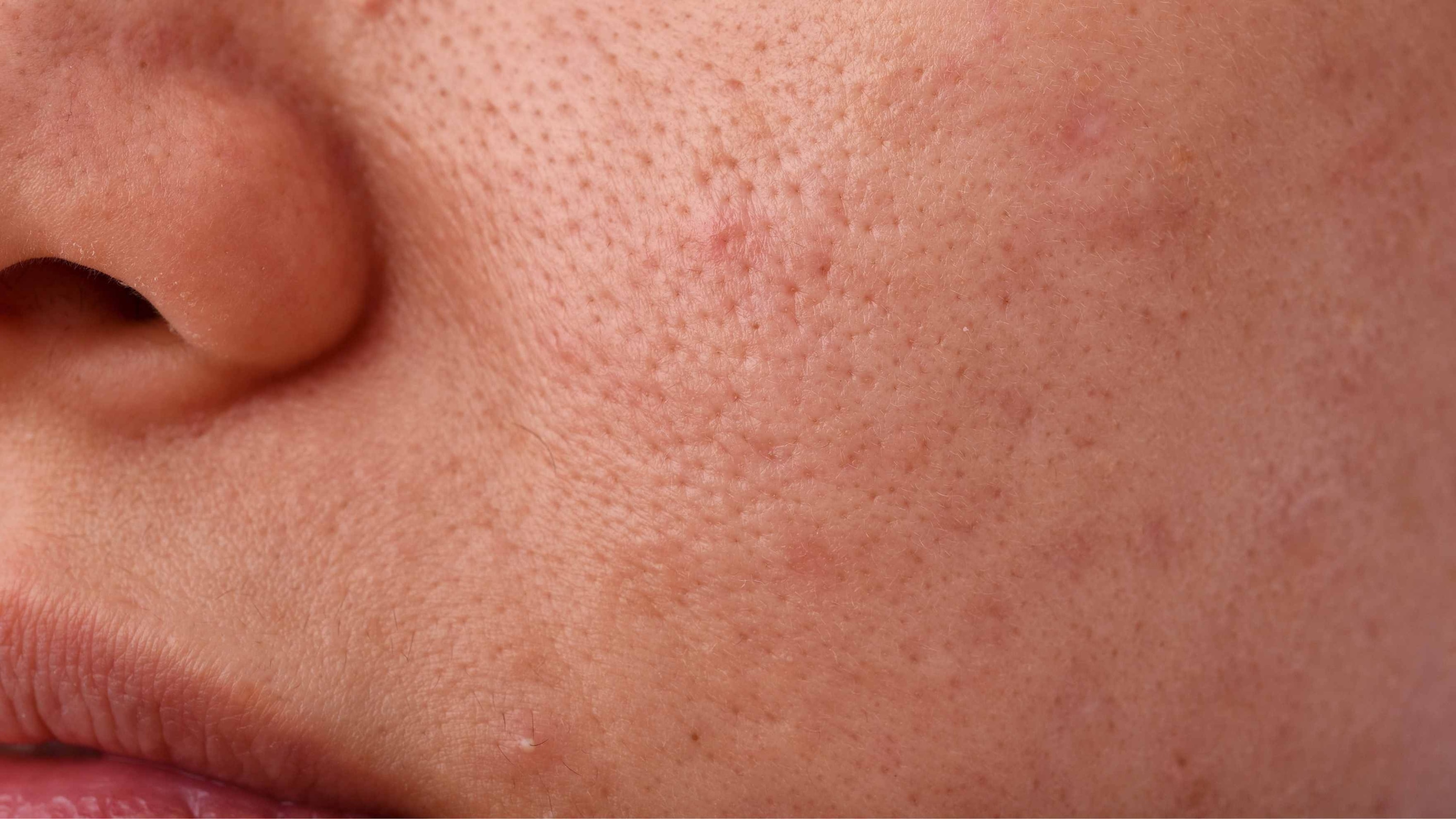 Minimises Pores