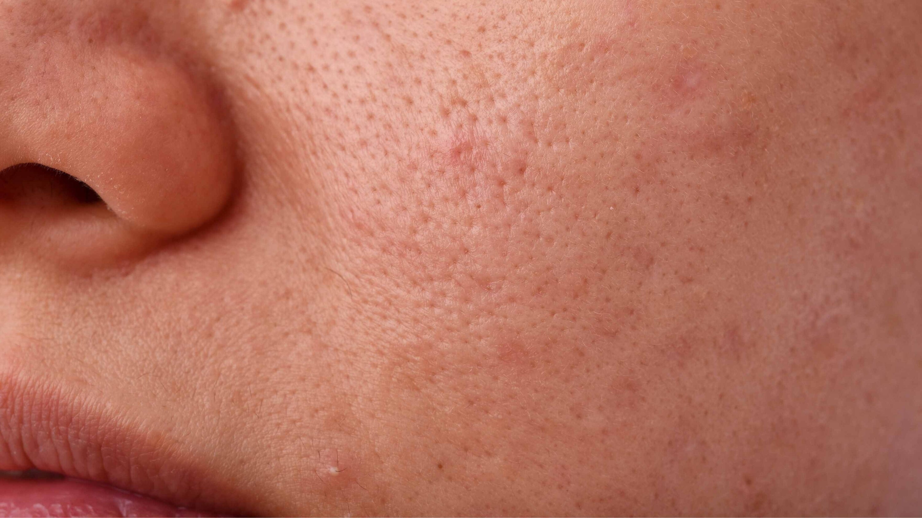 Minimises Pores