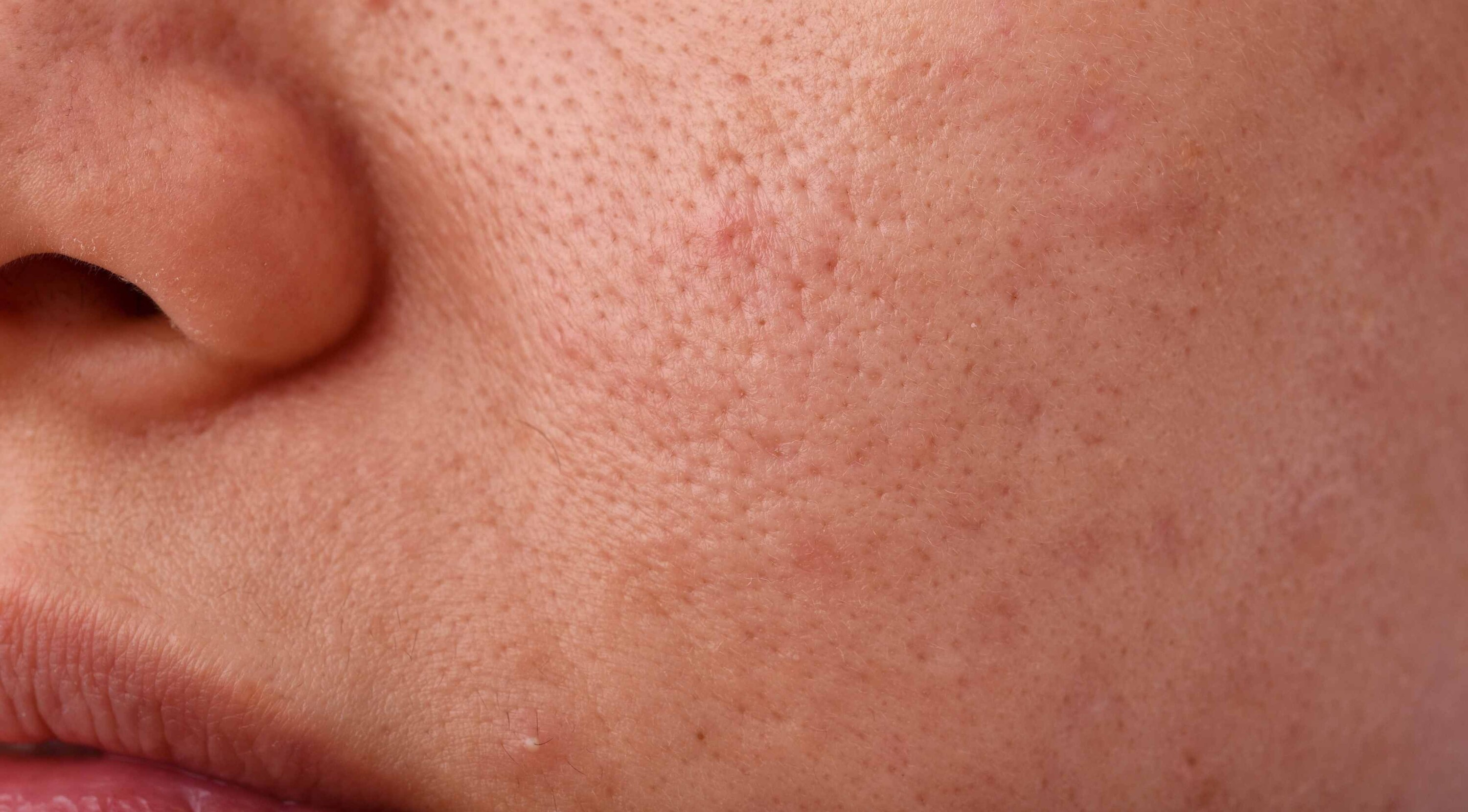 Minimises Pores