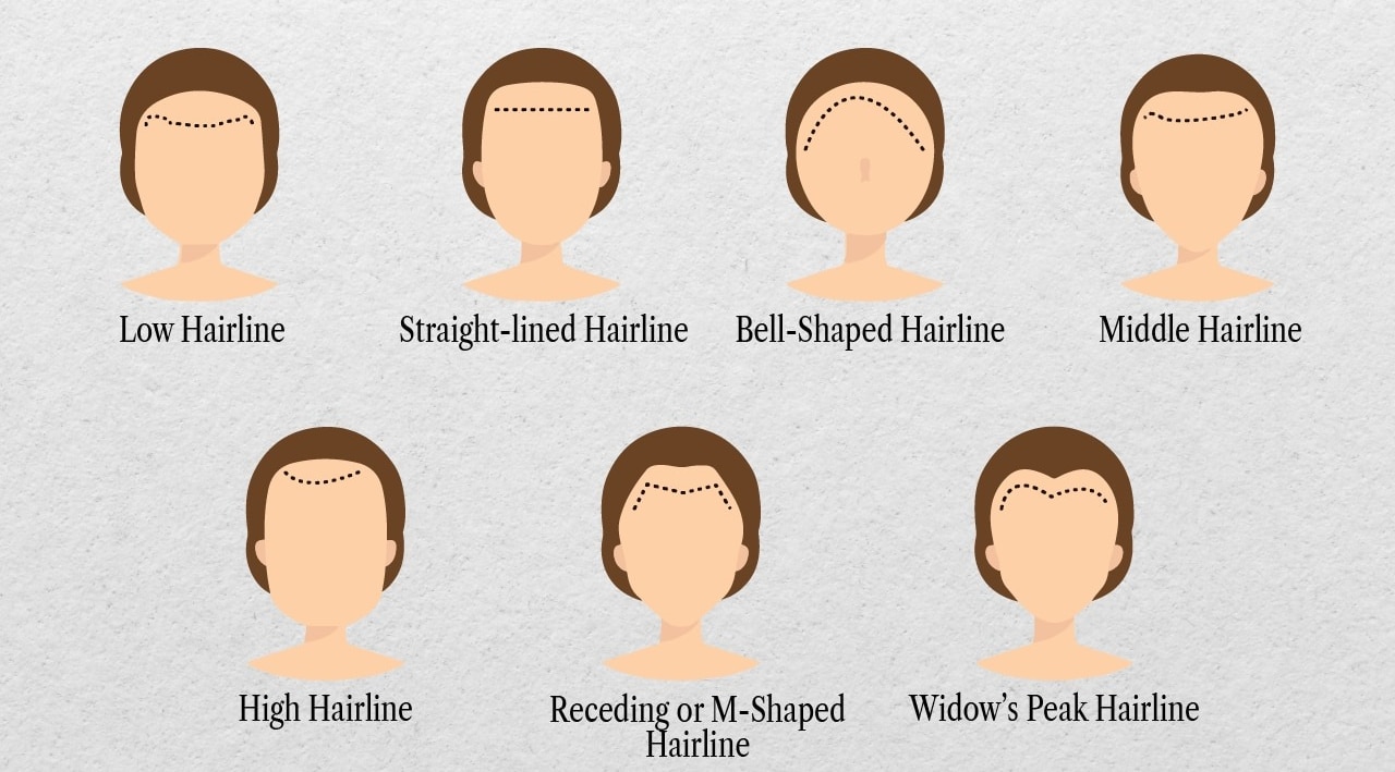 Types of hairlines in women