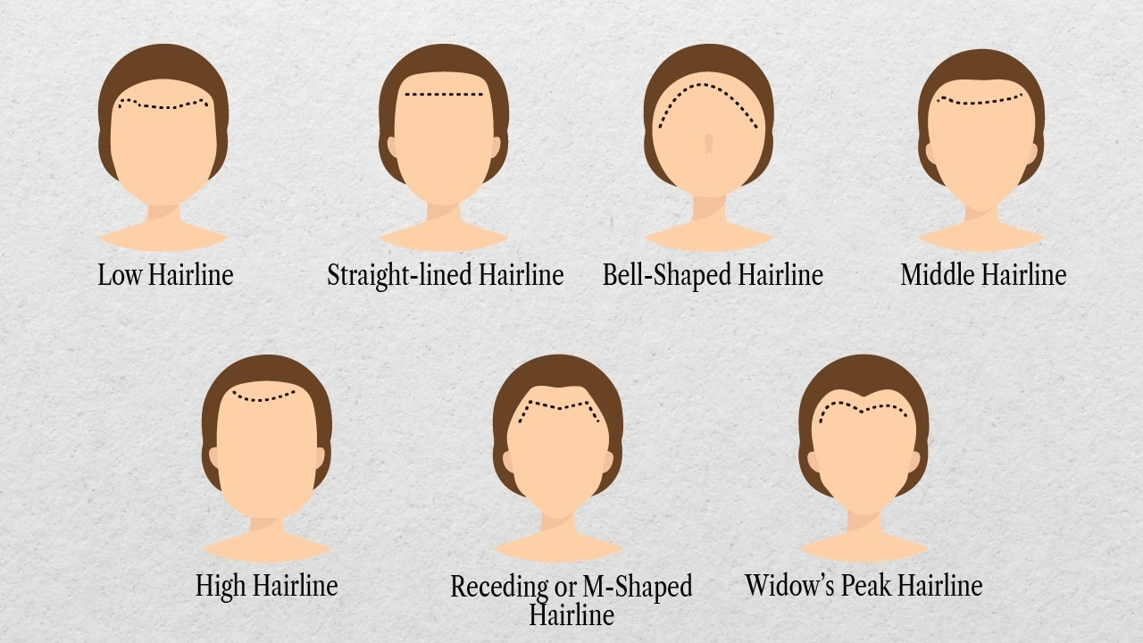 Types of hairlines in women