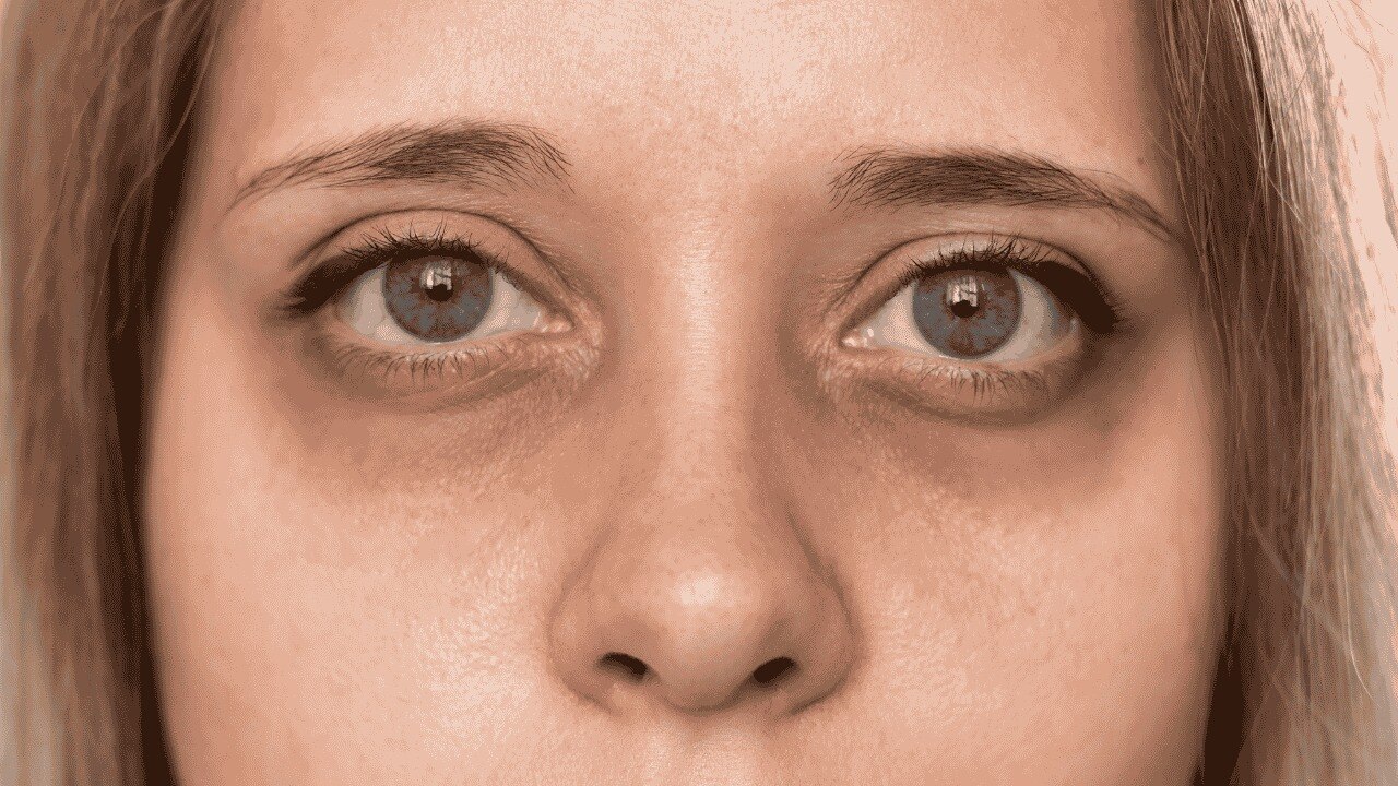 What Causes Puffy Eyes