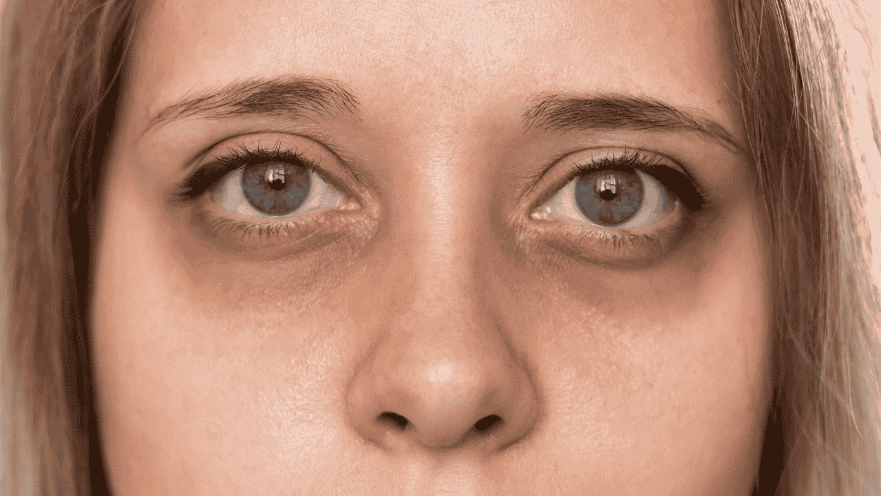 What Causes Puffy Eyes