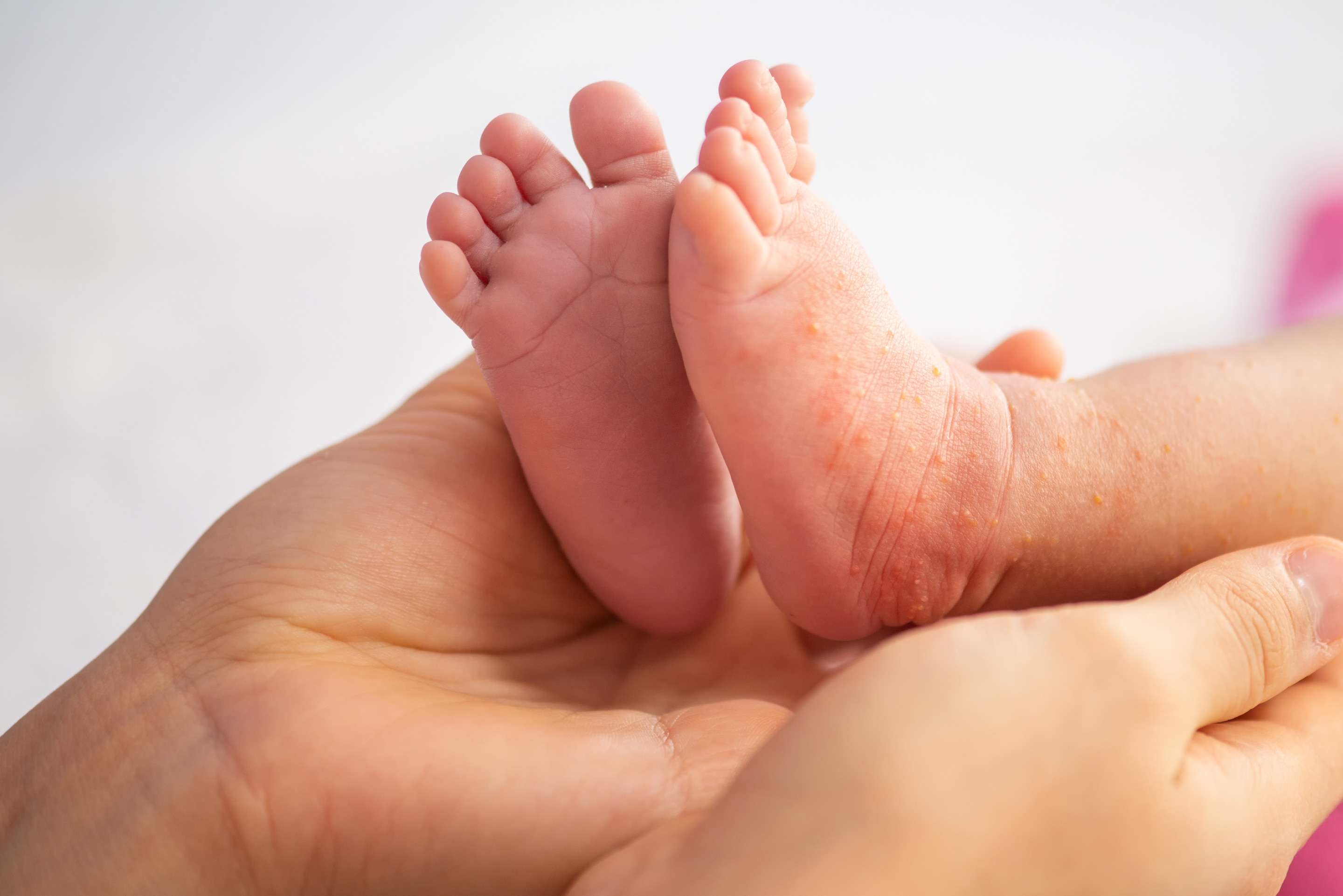 Bayi baru lahir yang memiliki alergi pada kulit kakinya