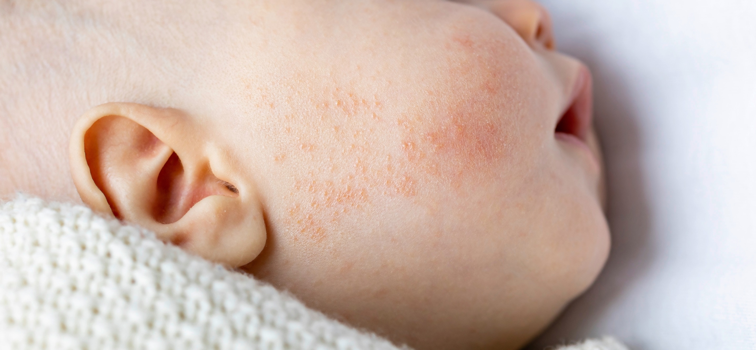 Wajah baji yang kemerahan di area pipi yang mengalami dermatitis atau iritasi